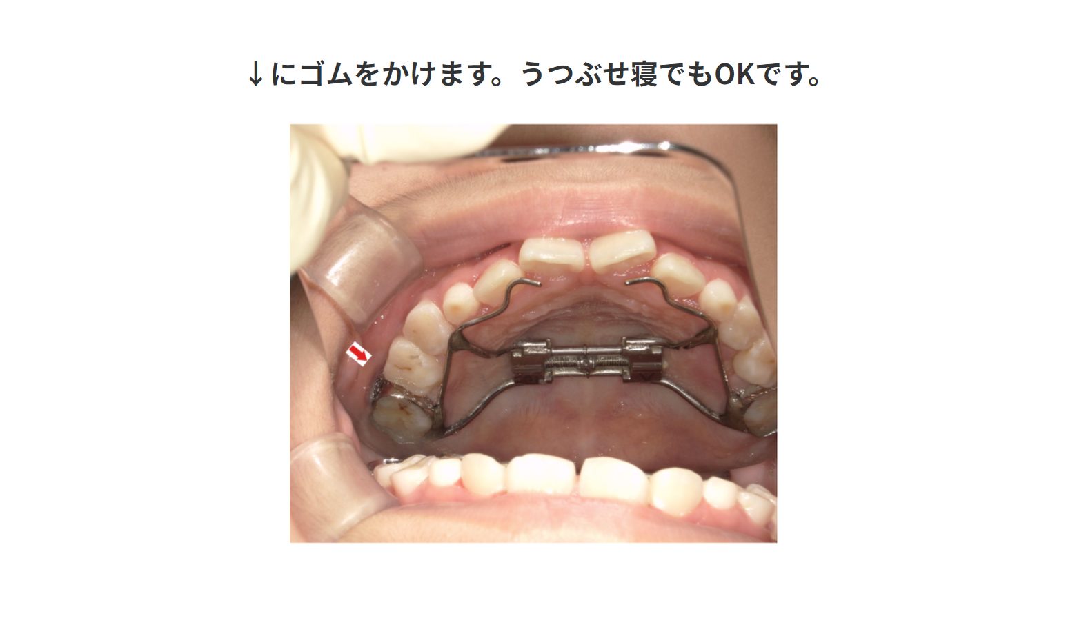 小児矯正⑧フェイスマスクについて | 東京のインビザライン矯正の専門医